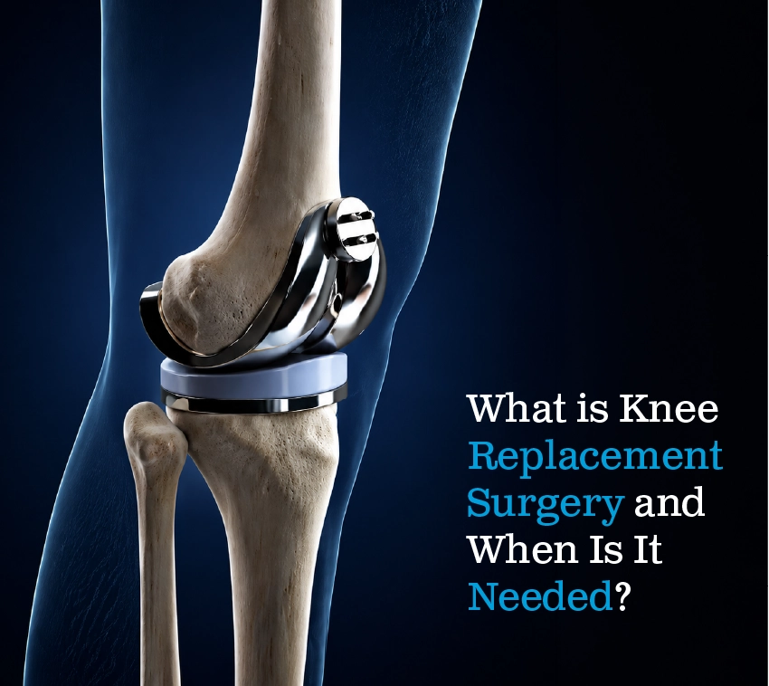 What Is Knee Replacement Surgery and When Is It Needed?